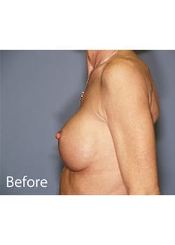 Breast Revision