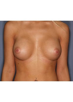 After Image: Breast Revision - front