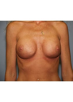 After Image: Breast Revision - front