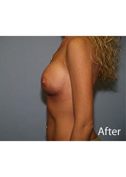 Breast Revision