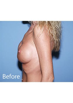Breast Revision