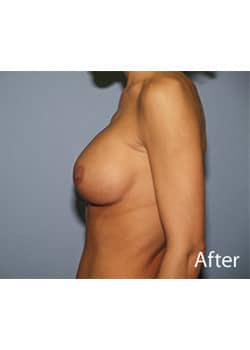 After Image: Breast Revision - other