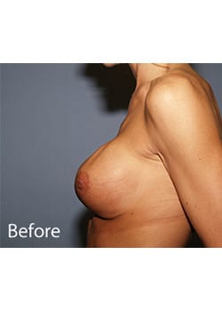 Before Image: Breast Revision - other