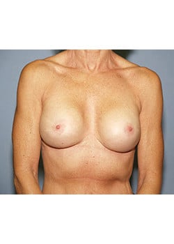 After Image: Breast Revision - front