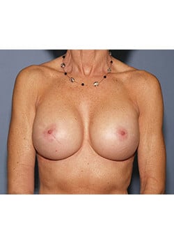 Before Image: Breast Revision - front