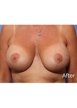 After Image: Breast Revision - front