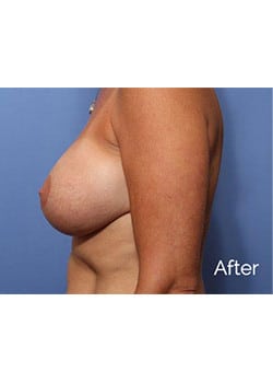 Breast Revision