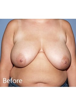 Before Image: Female Breast Reduction - front