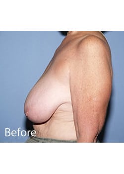 Female Breast Reduction