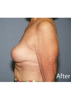 Female Breast Reduction
