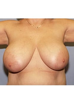 Before Image: Female Breast Reduction - front