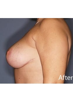 Female Breast Reduction