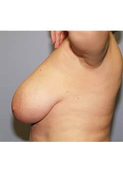 Female Breast Reduction
