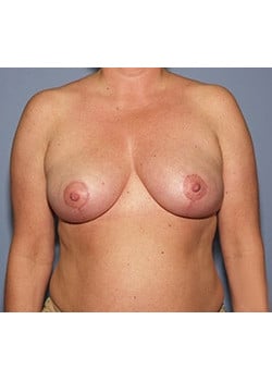 After Image: Female Breast Reduction - front