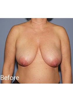 Before Image: Female Breast Reduction - front