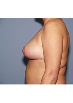 After Image: Female Breast Reduction - other