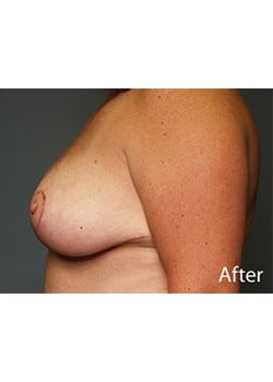 After Image: Female Breast Reduction - other