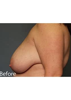 Before Image: Female Breast Reduction - other
