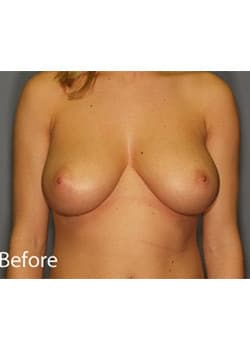 Before Image: Female Breast Reduction - front
