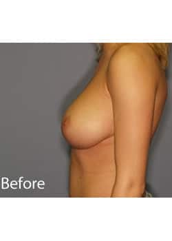 Female Breast Reduction