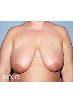 Before Image: Female Breast Reduction - front