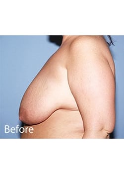 Before Image: Female Breast Reduction - other