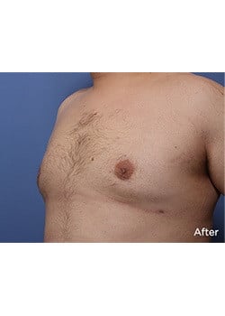 After Image: Male Breast Reduction - left-front-oblique