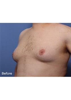 Before Image: Male Breast Reduction - left-front-oblique