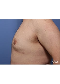 After Image: Male Breast Reduction - other