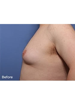 Before Image: Male Breast Reduction - other