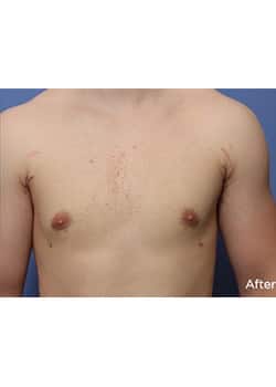 After Image: Male Breast Reduction - front