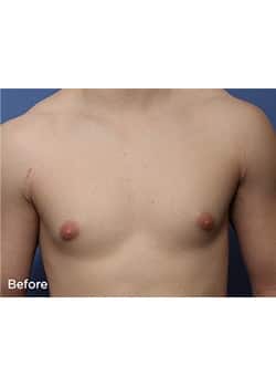 Before Image: Male Breast Reduction - front