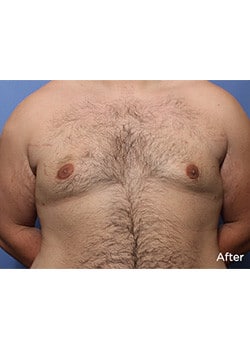 After Image: Male Breast Reduction - front