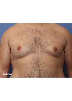 Before Image: Male Breast Reduction - front