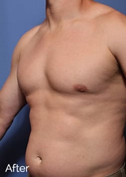 After Image: Male Breast Reduction - left-front-oblique