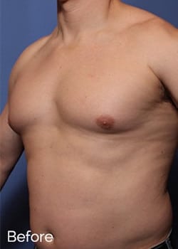 Before Image: Male Breast Reduction - left-front-oblique