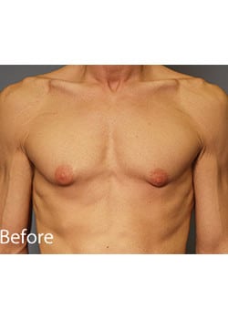 Before Image: Male Breast Reduction - front