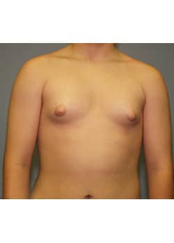 Before Image: Male Breast Reduction - front