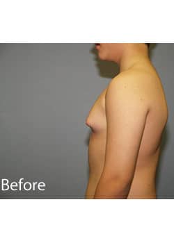 Male Breast Reduction