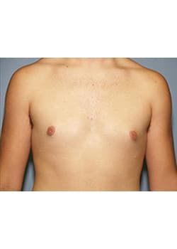 After Image: Male Breast Reduction - front