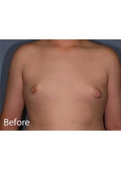 Before Image: Male Breast Reduction - front
