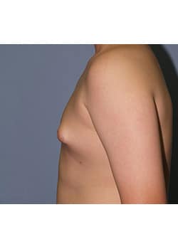 Male Breast Reduction