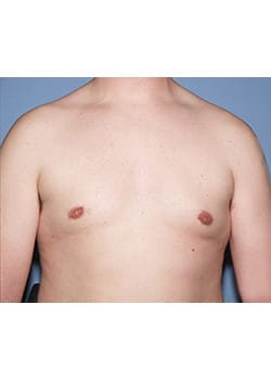 After Image: Male Breast Reduction - front