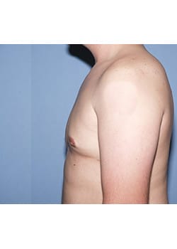 After Image: Male Breast Reduction - other