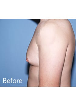 Before Image: Male Breast Reduction - other