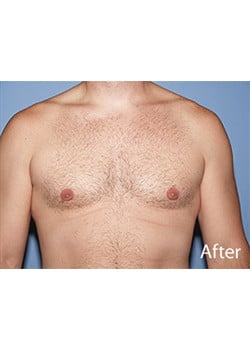 After Image: Male Breast Reduction - front