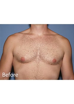 Before Image: Male Breast Reduction - front