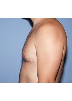 After Image: Male Breast Reduction - other