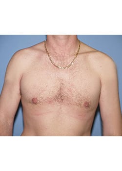 After Image: Male Breast Reduction - front