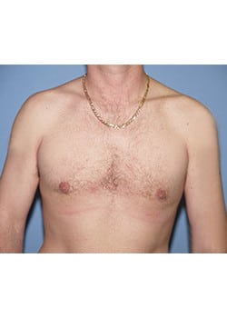 Male Breast Reduction